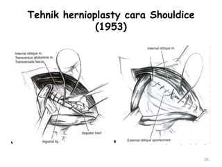 Tehnik hernioplasty cara Shouldice
(1953)
26
 