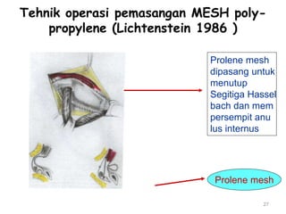 Tehnik operasi pemasangan MESH poly-
propylene (Lichtenstein 1986 )
27
Prolene mesh
dipasang untuk
menutup
Segitiga Hassel
bach dan mem
persempit anu
lus internus
Prolene mesh
 