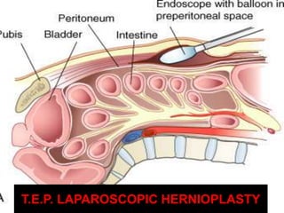 28
T.E.P. LAPAROSCOPIC HERNIOPLASTY
 