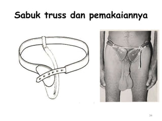 Sabuk truss dan pemakaiannya
34
 
