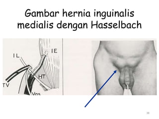 Gambar hernia inguinalis
medialis dengan Hasselbach
36
 