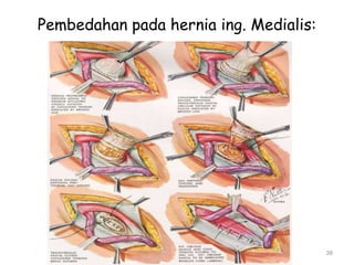 Pembedahan pada hernia ing. Medialis:
38
 