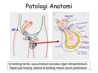 Patologi Anatomi
4
Isi kantong hernia: usus,omentum,buli,atau organ retroperitoneum,
Dapat pula kosong, karena isi kantong masuk cavum peritoneum.
 