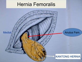 40
Hernia Femoralis
Anulus Fem.
KANTONG HERNIA
Medial
 