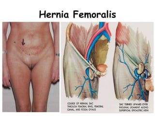 Hernia Femoralis
41
 