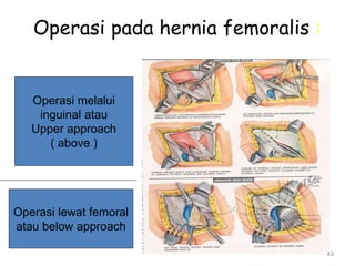 Operasi pada hernia femoralis :
43
Operasi lewat femoral
atau below approach
Operasi melalui
inguinal atau
Upper approach
( above )
 