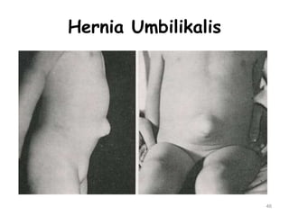Hernia Umbilikalis
46
 