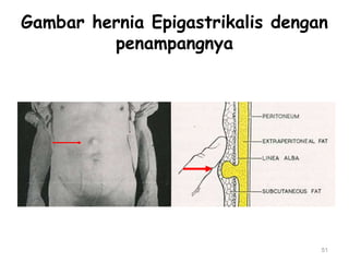 Gambar hernia Epigastrikalis dengan
penampangnya
51
 