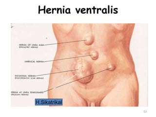 Hernia ventralis
53
H.Sikatrikal
 