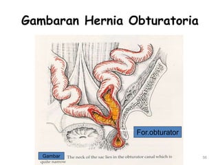 Gambaran Hernia Obturatoria
56
Gambar
For.obturator
 