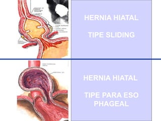57
HERNIA HIATAL
TIPE SLIDING
HERNIA HIATAL
TIPE PARA ESO
PHAGEAL
 