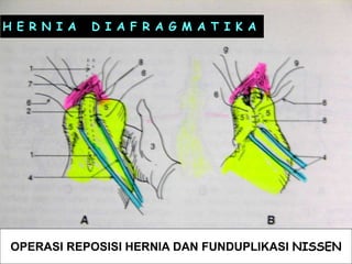 61
OPERASI REPOSISI HERNIA DAN FUNDUPLIKASI NISSEN
H E R N I A D I A F R A G M A T I K A
 