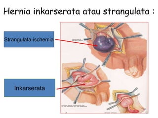 Hernia inkarserata atau strangulata :
63
Strangulata-ischemia
Inkarserata
 
