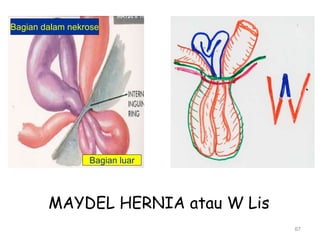 67
MAYDEL HERNIA atau W Lis
Bagian luar
Bagian dalam nekrose
 