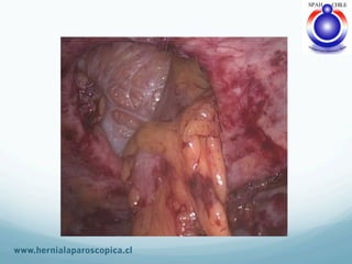 Hernia Paracolostomica 