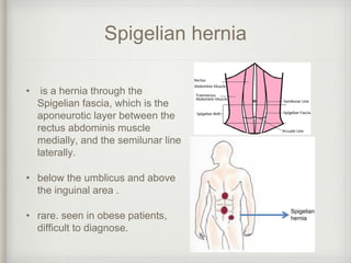 Spigelian hernia
• is a hernia through the
Spigelian fascia, which is the
aponeurotic layer between the
rectus abdominis muscle
medially, and the semilunar line
laterally.
• below the umblicus and above
the inguinal area .
• rare. seen in obese patients,
difficult to diagnose.
 