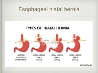 Esophageal hiatal hernia
 
