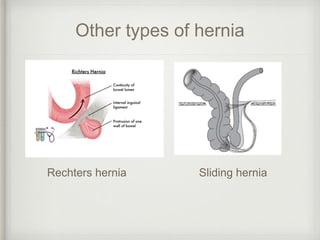 Other types of hernia
Sliding herniaRechters hernia
 