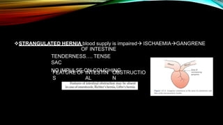 STRANGULATED HERNIA blood supply is impaired ISCHAEMIAGANGRENE
OF INTESTINE
TENDERNESS…. TENSE
SAC
NO IMPULSE ON COUGHING
FEATURE
S
OF INTESTIN
AL
OBSTRUCTIO
N
 