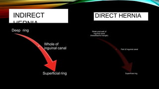 Deep ring Weak post wall of
inguinal canal
(hesselbachs triangle)
Whole of
inguinal canal Part of inguinal canal
Superficial ring Superficial ring
DIRECT HERNIA
INDIRECT
HERNIA
 