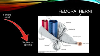 FEMORA
L
HERNI
A
Femoral
canal
Saphenous
opening
 