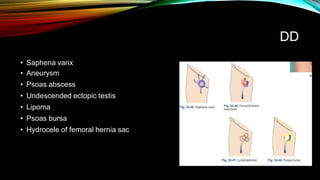 DD
• Saphena varix
• Aneurysm
• Psoas abscess
• Undescended ectopic testis
• Lipoma
• Psoas bursa
• Hydrocele of femoral hernia sac
 