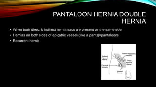 PANTALOON HERNIA DOUBLE
HERNIA
• When both direct & indirect hernia sacs are present on the same side
• Hernias on both sides of epigatric vessels(like a pants)=pantaloons
• Recurrent hernia
 