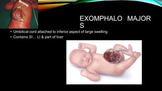EXOMPHALO
S
MAJOR
• Umbilical cord attached to inferior aspect of large swelling
• Contains SI… LI & part of liver
 