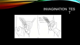 INVAGINATION TES
T
 