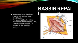 BASSIN
I
REPAI
R
• Is frequently used for indirect
inguinal hernias and small
direct hernias
• The conjoined tendon of the
transversus abdominis and the
internal oblique muscles is
sutured to
ligament
the inguinal
 