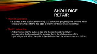 SHOULDICE
REPAIR
• The first suture line
• is started at the pubic tubercle using 3-0 continuous polypropylene, and the white
line is approximated to the free edge of the inferior transversalis fascial flap.
2nd
• The suture line :
• At the internal ring the suture is tied and then continued medially by
approximating the free edge of the superior flap to the shelving edge of the
inguinal ligament. When the pubic tubercle is reached, the suture is tied and divided.
 