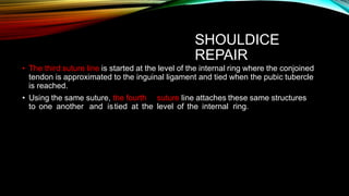 SHOULDICE
REPAIR
• The third suture line is started at the level of the internal ring where the conjoined
tendon is approximated to the inguinal ligament and tied when the pubic tubercle
is reached.
• Using the same suture, the fourth suture line attaches these same structures
to one another and istied at the level of the internal ring.
 