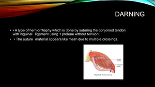 DARNING
• • A type of herniorrhaphy which is done by suturing the conjoined tendon
with inguinal
• • The suture
ligament using 1 prolene without tension.
material appears like mesh due to multiple crossings.
 