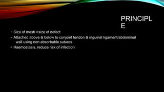 PRINCIPL
E
• Size of mesh >size of defect
• Attached above & below to conjoint tendon & inguinal ligament/abdominal
wall using non absorbable sutures
• Haemostasis, reduce risk of infection
 