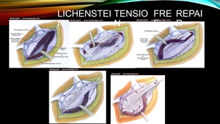 LICHENSTEI
N
TENSIO
N
FRE
E
REPAI
R
 