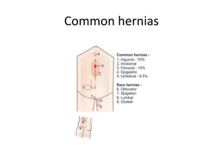 Common hernias
 