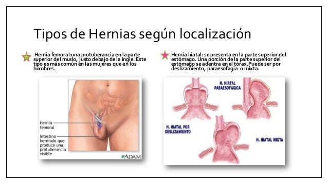 El emplasto a la osteocondrosis de la columna vertebral