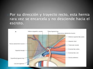Por su dirección y trayecto recto, esta hernia 
rara vez se encarcela y no desciende hacia el 
escroto. 
 