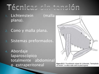 1. Lichtenstein (malla 
plana). 
2. Cono y malla plana. 
3. Sistemas preformados. 
4. Abordaje 
laparoscópico 
totalmente abdominal 
o extraperitoneal 
 