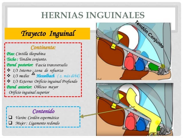 Tipos de hernia femoral