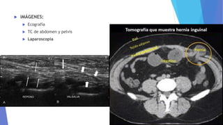  IMÁGENES:
 Ecografía
 TC de abdomen y pelvis
 Laparoscopía
 