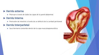  Protruye a través de todas las capas de la pared abdominal
 Protrusión de intestino a través de un defecto de la cavidad peritoneal
 Saco herniario contenido dentro de la capa musculoaponeurótica
 