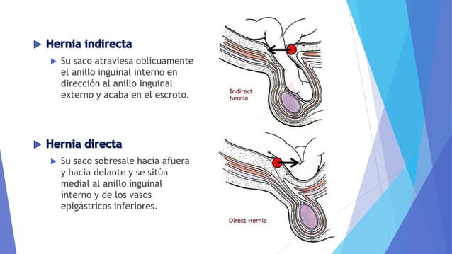 Hernia Inguinal: Qué Es, Causas, Tipos, Síntomas Y Tratamiento – PDDYE