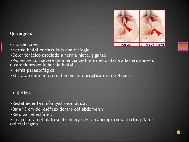 tratamiento quirurgico de hernia hiatal pdf tratamiento quirurgico de hernia hiatal pdf