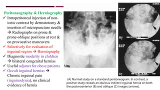Hernias | PPTX