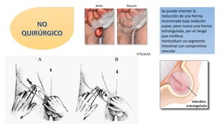 Se puede intentar la
reducción de una hernia
incarcerada bajo sedación
suave, pero nunca una hernia
estrangulada, por el riesgo
que conlleva
reintroducir un segmento
intestinal con compromiso
vascular.
 