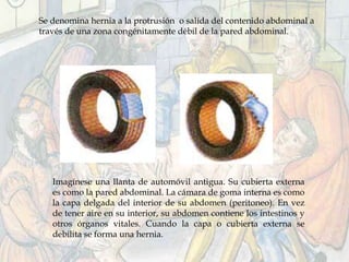 Imagínese una llanta de automóvil antigua. Su cubierta externa
es como la pared abdominal. La cámara de goma interna es como
la capa delgada del interior de su abdomen (peritoneo). En vez
de tener aire en su interior, su abdomen contiene los intestinos y
otros órganos vitales. Cuando la capa o cubierta externa se
debilita se forma una hernia.
Se denomina hernia a la protrusión o salida del contenido abdominal a
través de una zona congénitamente débil de la pared abdominal.
 