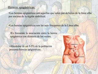 Hernias epigástricas:
•Las hernias epigástricas son aquellas que salen por defectos de la línea alba
por encima de la región umbilical.
•Las hernias epigástricas son las más frecuentes de la Línea alba.
•Es frecuente la asociación entre la hernia
epigástrica con diástasis de los rectos.
•Alrededor de un 3-5% de la población
presenta hernias epigástricas.
 