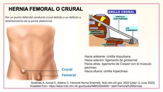 Por un punto débil del conducto crural debido a un defecto o
debilitamiento de la pared abdominal
Hacia adelante: cintilla iliopubiana
Hacia adentro: ligamento de gimbernat
Hacia atrás: ligamento de Cooper con el músculo
pectíneo
Hacia afuera: cintilla liopectinea
Goethals A, Azmat C, Adams C. Femoral Hernia [Internet]. Ncbi.nlm.nih.gov. 2022 [cited 12 June 2022].
Available from: https://www.ncbi.nlm.nih.gov/books/NBK535449/#:~:text=Femoral%20hernias
 