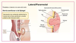 Lateral/Pararrectal
Paralelos o lateral a la vaina del recto
Hernia semilunar o de Spiegel
Herniación de contenido abdominal a
través de la línea semilunar y borde
externo del músculo recto
 
